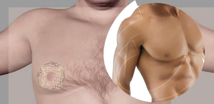 Ginecomastia - cirurgia para redução das glândulas nas mamas masculinas