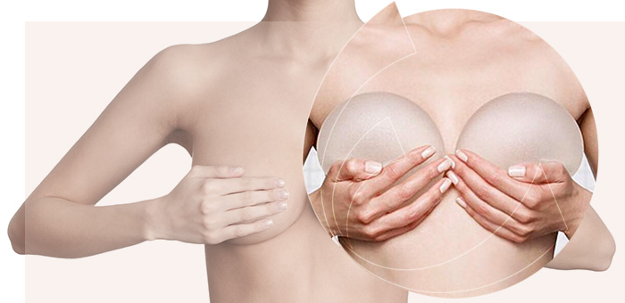 Mamoplastia de Aumento - prótese de silicone